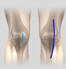 Minimally Invasive Partial Knee Arthroplasty