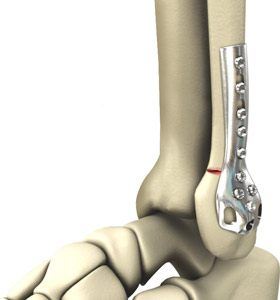 Ankle Fracture Fixation 