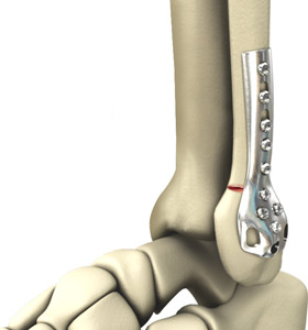 Ankle Fracture Fixation