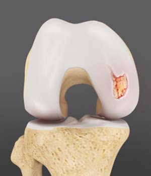 Chondral (Articular Cartilage Defects)