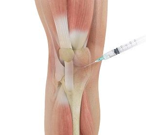 Cortisone Injections