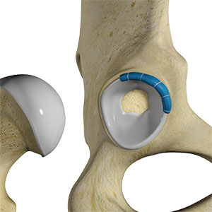 Labrum & Biceps repair