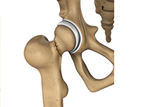 Outpatient Joint Replacement