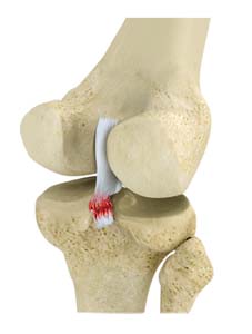 PCL Reconstruction