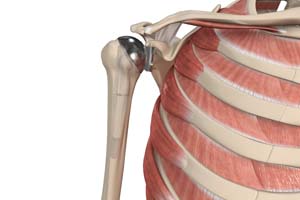 Shoulder Joint Replacement